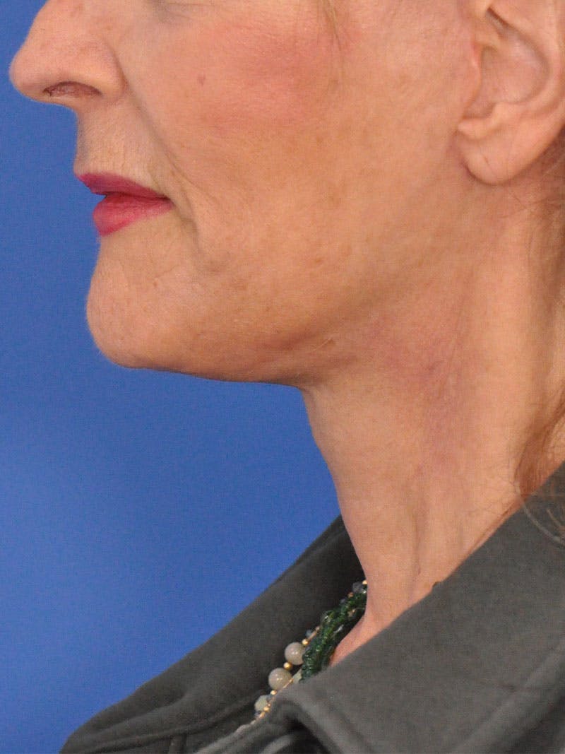 Neck Lift Before & After Gallery - Patient 165509 - Image 10