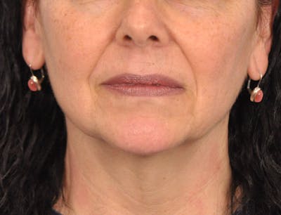 Facelift Before & After Gallery - Patient 353999 - Image 1
