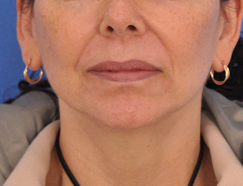 Neck Lift Before & After Gallery - Patient 138575 - Image 4