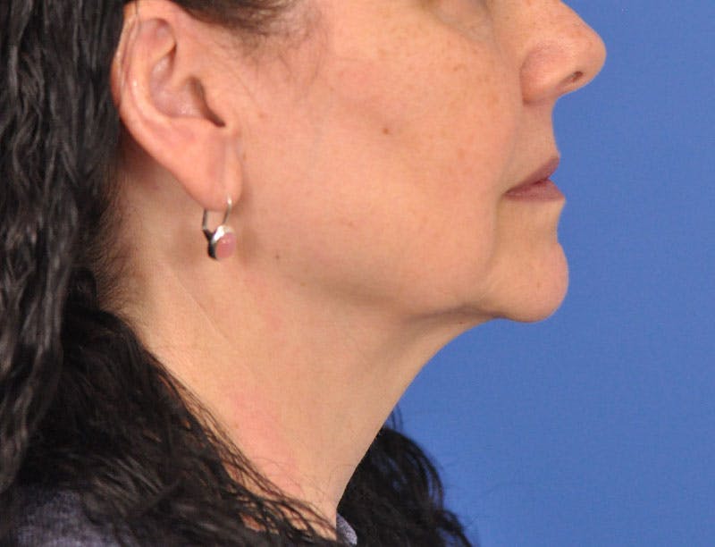 Facelift Before & After Gallery - Patient 353999 - Image 3