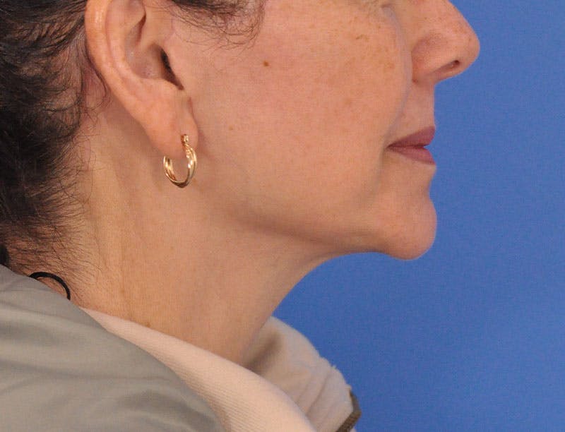 Facelift Before & After Gallery - Patient 353999 - Image 4