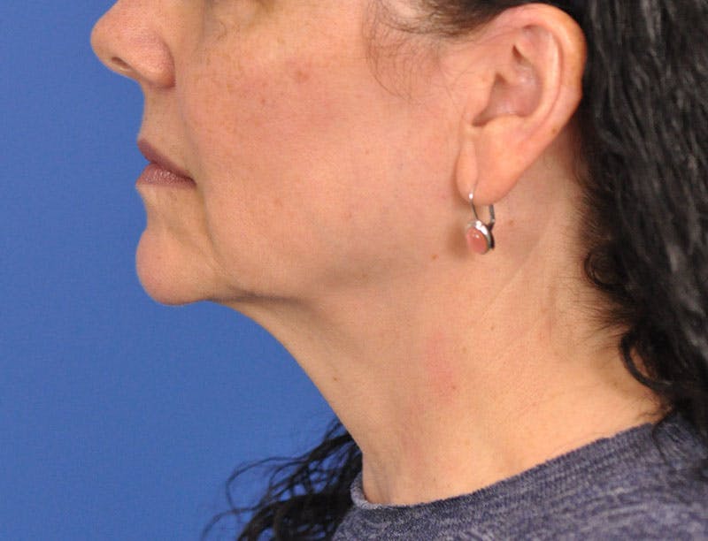 Facelift Before & After Gallery - Patient 353999 - Image 5