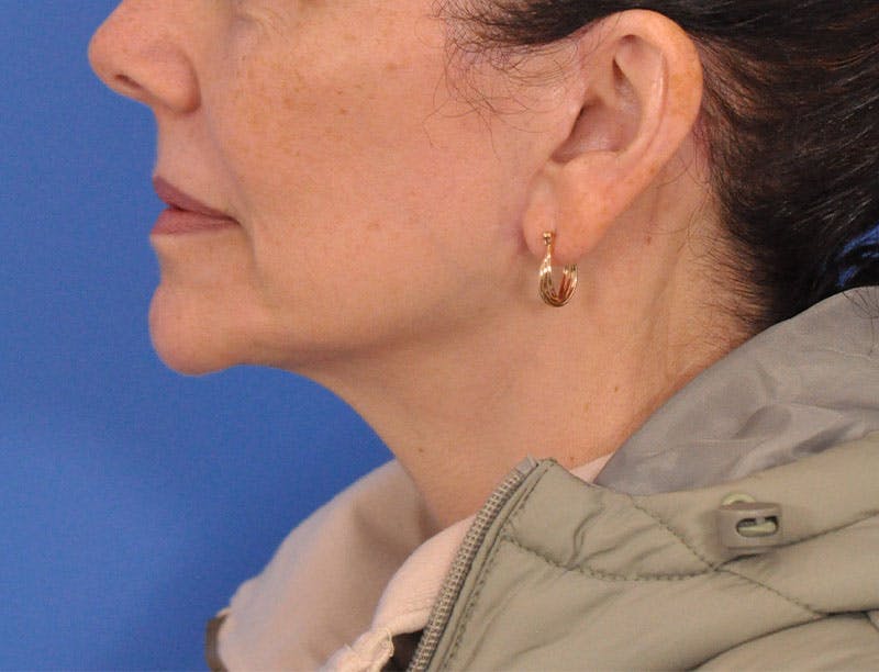 Facelift Before & After Gallery - Patient 353999 - Image 6