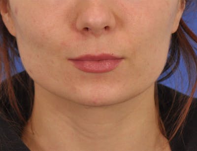 Lip Lift Before & After Gallery - Patient 378084 - Image 1