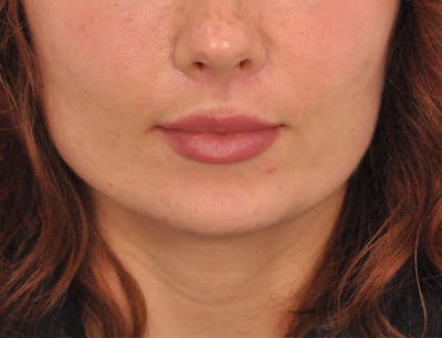 Lip Lift Before & After Gallery - Patient 378084 - Image 2