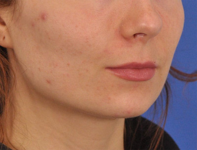 Lip Lift Before & After Gallery - Patient 378084 - Image 3