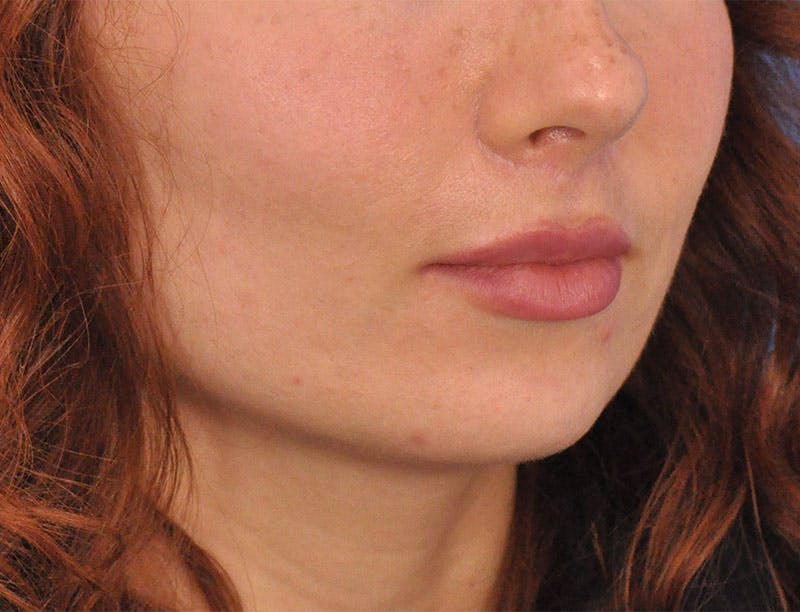Lip Lift Before & After Gallery - Patient 378084 - Image 4