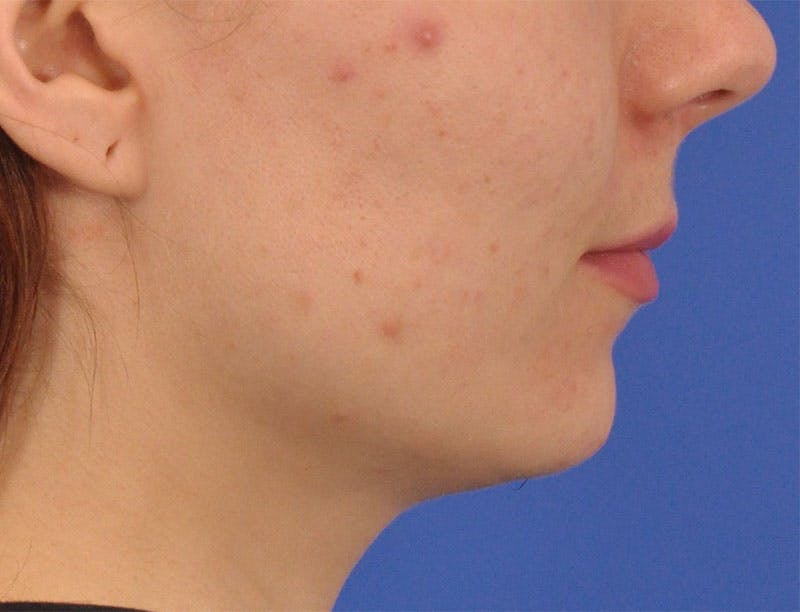 Lip Lift Before & After Gallery - Patient 378084 - Image 5