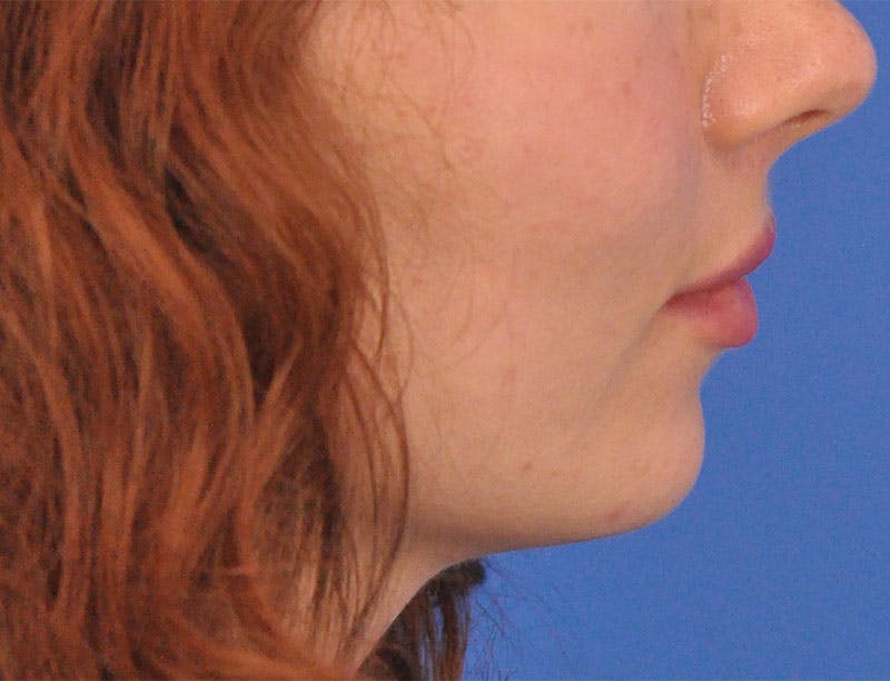 Lip Lift Before & After Gallery - Patient 378084 - Image 6