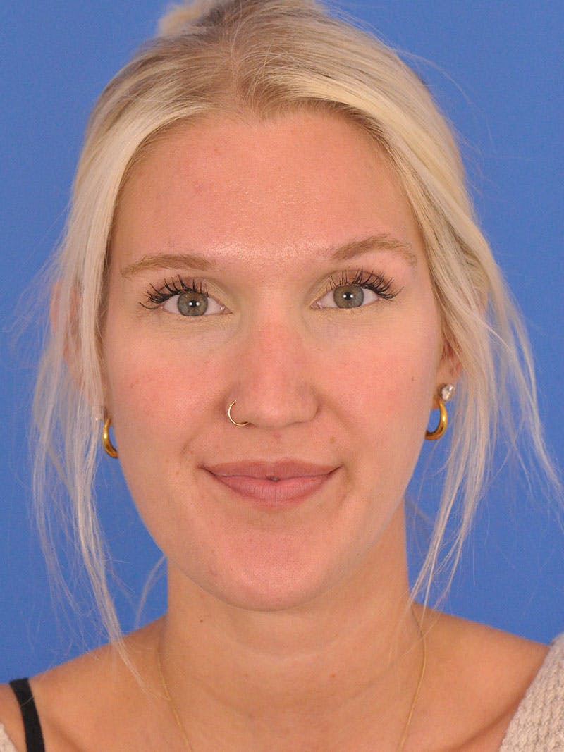 Rhinoplasty Before & After Gallery - Patient 618273 - Image 5