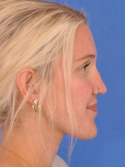 Rhinoplasty Before & After Gallery - Patient 618273 - Image 1