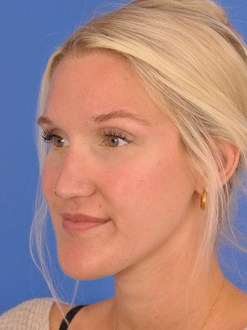 Rhinoplasty Before & After Gallery - Patient 618273 - Image 9