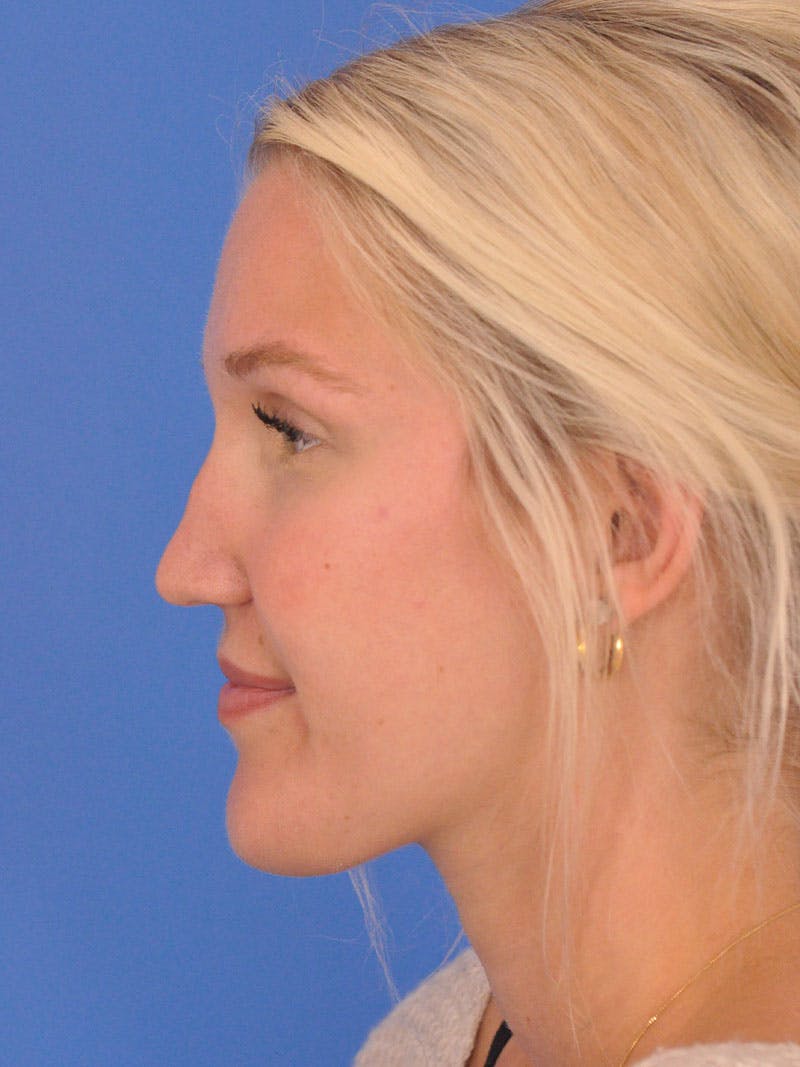 Rhinoplasty Before & After Gallery - Patient 618273 - Image 11