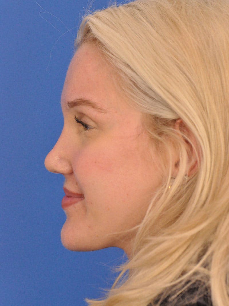 Rhinoplasty Before & After Gallery - Patient 618273 - Image 12