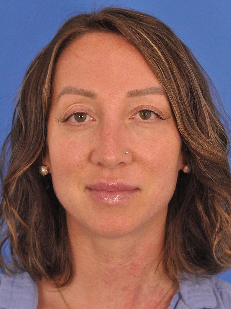 Rhinoplasty Before & After Gallery - Patient 376930 - Image 6