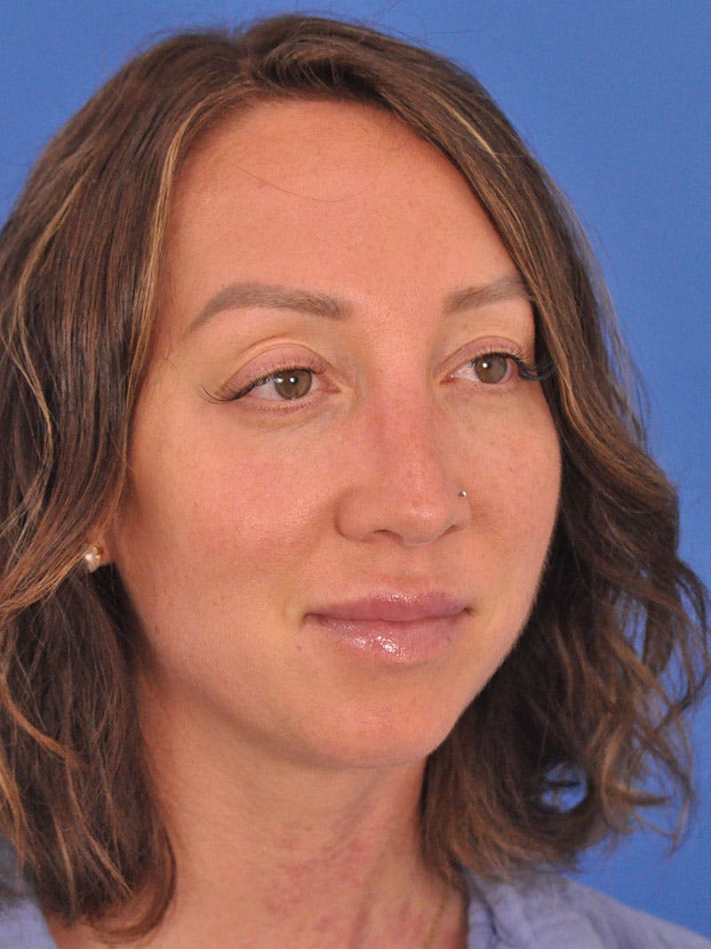 Rhinoplasty Before & After Gallery - Patient 376930 - Image 4
