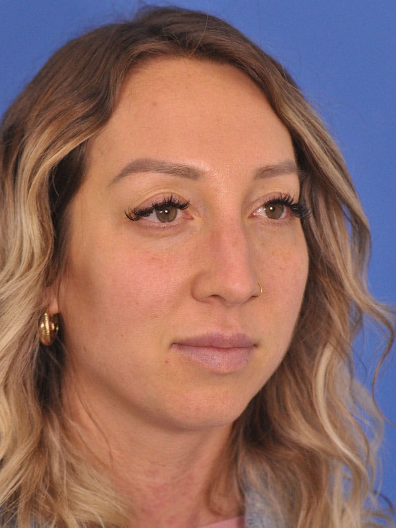 Rhinoplasty Before & After Gallery - Patient 376930 - Image 3