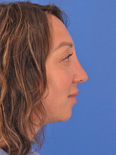 Rhinoplasty Before & After Gallery - Patient 376930 - Image 2