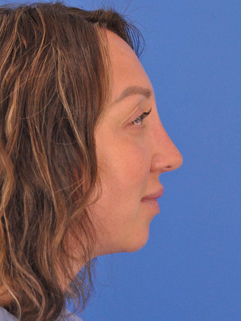 Rhinoplasty Before & After Gallery - Patient 376930 - Image 1