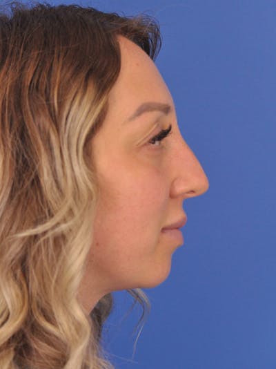 Rhinoplasty Before & After Gallery - Patient 376930 - Image 2