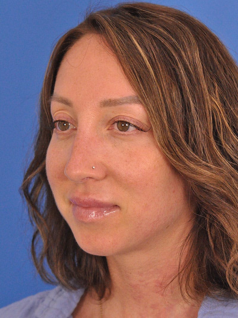 Rhinoplasty Before & After Gallery - Patient 376930 - Image 7