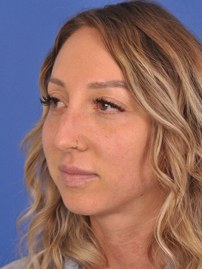 Rhinoplasty Before & After Gallery - Patient 376930 - Image 8