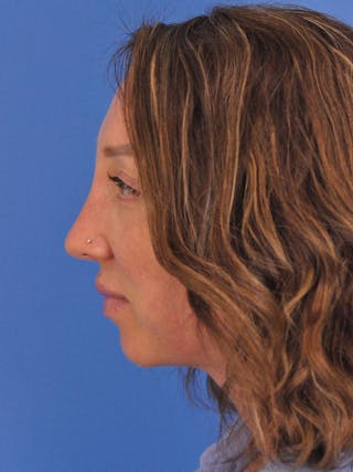 Rhinoplasty Before & After Gallery - Patient 376930 - Image 10