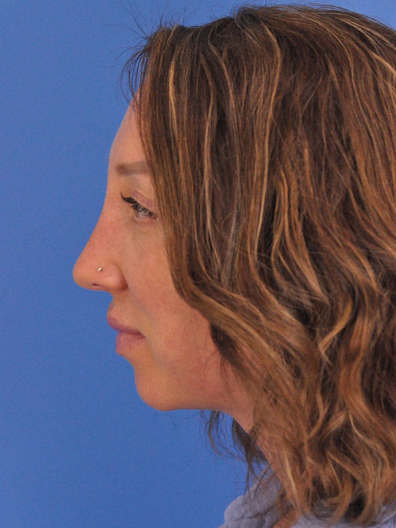Rhinoplasty Before & After Gallery - Patient 376930 - Image 9