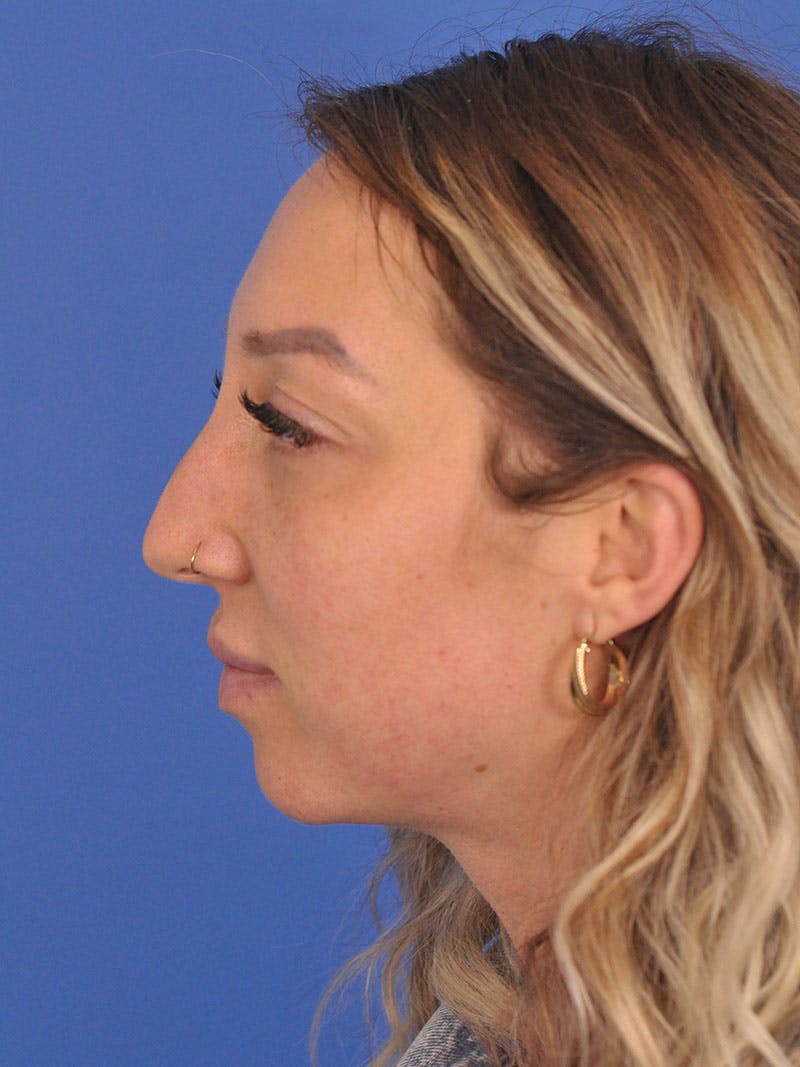 Rhinoplasty Before & After Gallery - Patient 376930 - Image 9