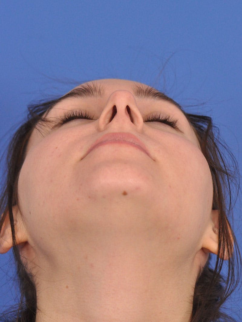 Rhinoplasty Before & After Gallery - Patient 216708 - Image 7