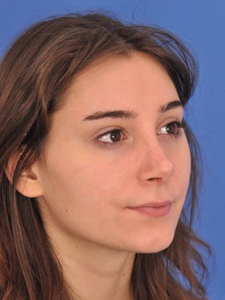 Rhinoplasty Before & After Gallery - Patient 216708 - Image 4