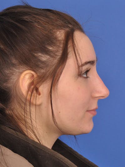 Rhinoplasty Before & After Gallery - Patient 216708 - Image 1