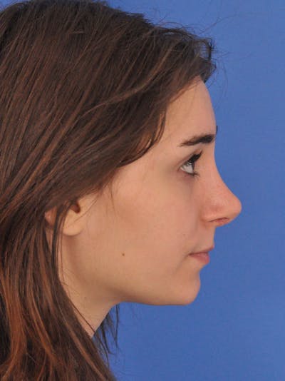 Rhinoplasty Before & After Gallery - Patient 216708 - Image 2