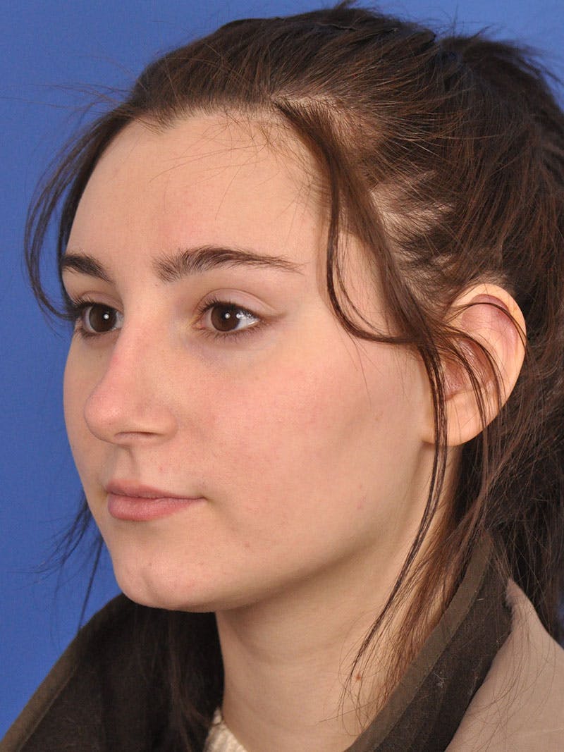 Rhinoplasty Before & After Gallery - Patient 216708 - Image 9