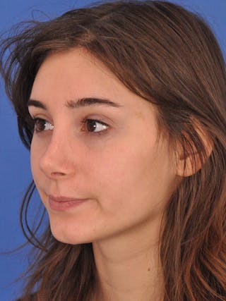 Rhinoplasty Before & After Gallery - Patient 216708 - Image 10