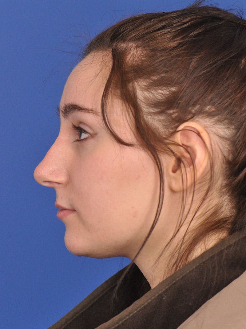 Rhinoplasty Before & After Gallery - Patient 216708 - Image 11