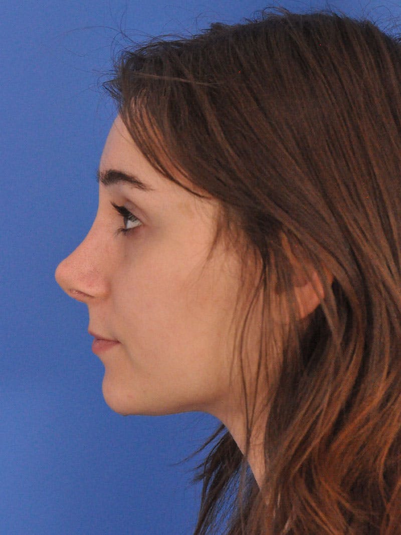 Rhinoplasty Before & After Gallery - Patient 216708 - Image 12