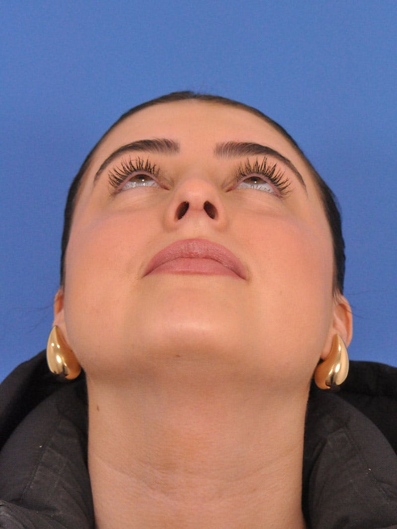 Rhinoplasty Before & After Gallery - Patient 339939 - Image 6