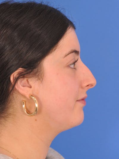 Rhinoplasty Before & After Gallery - Patient 339939 - Image 1