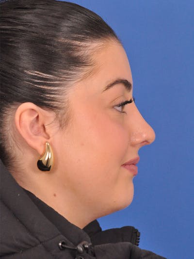 Rhinoplasty Before & After Gallery - Patient 339939 - Image 2