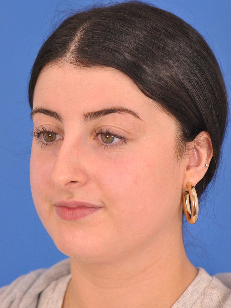 Rhinoplasty Before & After Gallery - Patient 339939 - Image 9