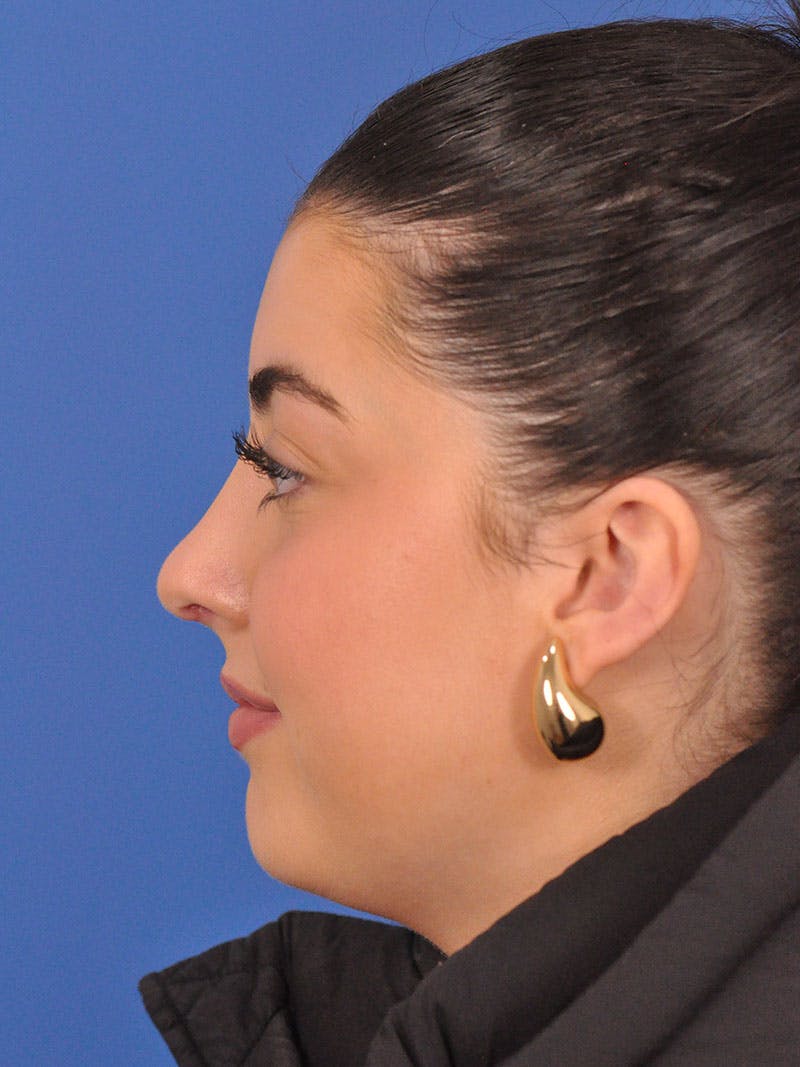 Rhinoplasty Before & After Gallery - Patient 339939 - Image 12