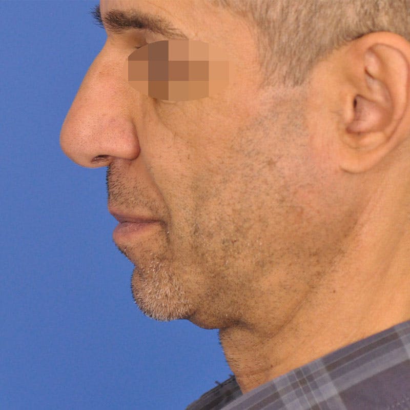 Rhinoplasty Before & After Gallery - Patient 221309 - Image 1