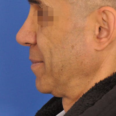 Rhinoplasty Before & After Gallery - Patient 221309 - Image 2