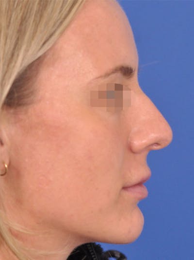 Rhinoplasty Before & After Gallery - Patient 354695 - Image 1