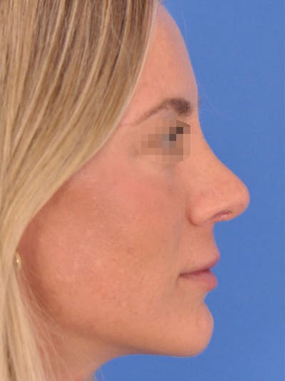 Rhinoplasty Before & After Gallery - Patient 354695 - Image 2