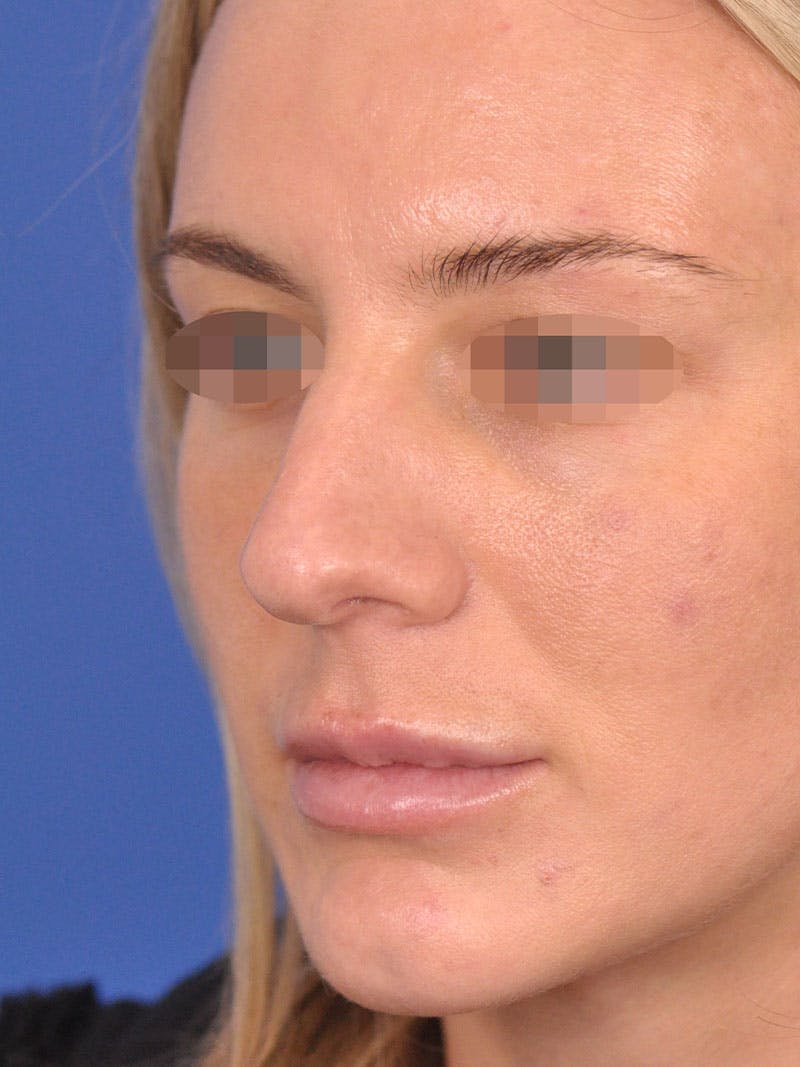 Rhinoplasty Before & After Gallery - Patient 354695 - Image 3