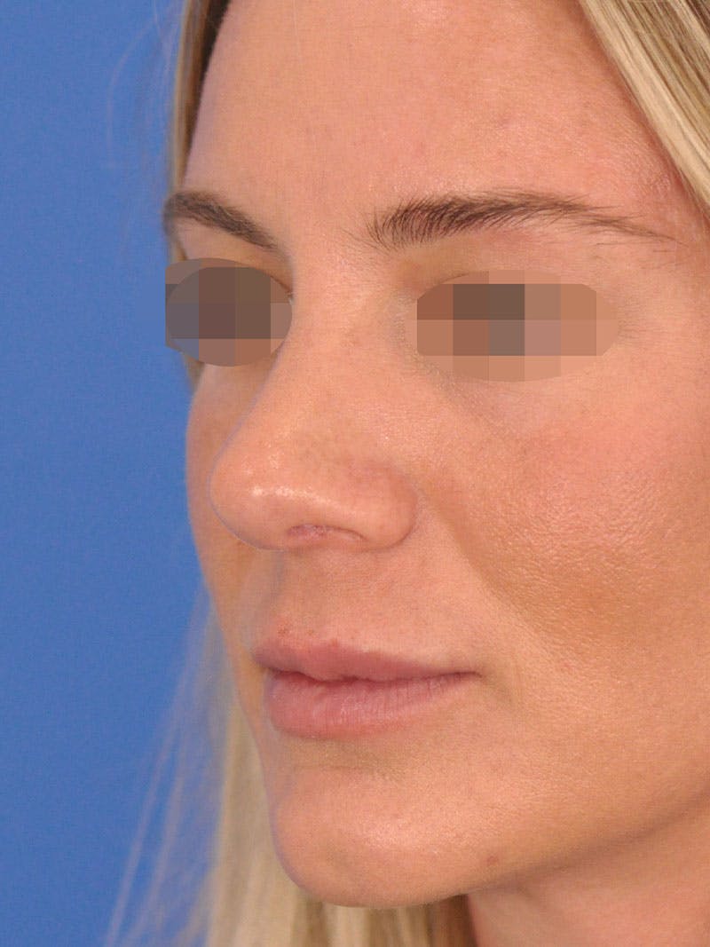 Rhinoplasty Before & After Gallery - Patient 354695 - Image 4