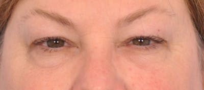 Blepharoplasty Before & After Gallery - Patient 324611 - Image 1