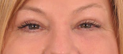 Blepharoplasty Before & After Gallery - Patient 324611 - Image 2